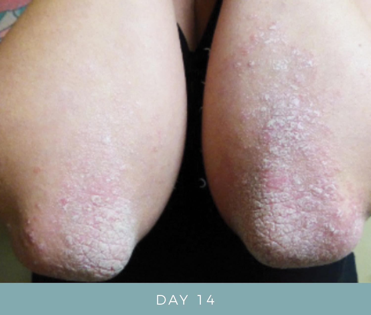 Before and After - Psoriasis