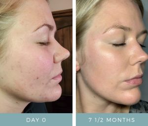 Before & After - Acne
