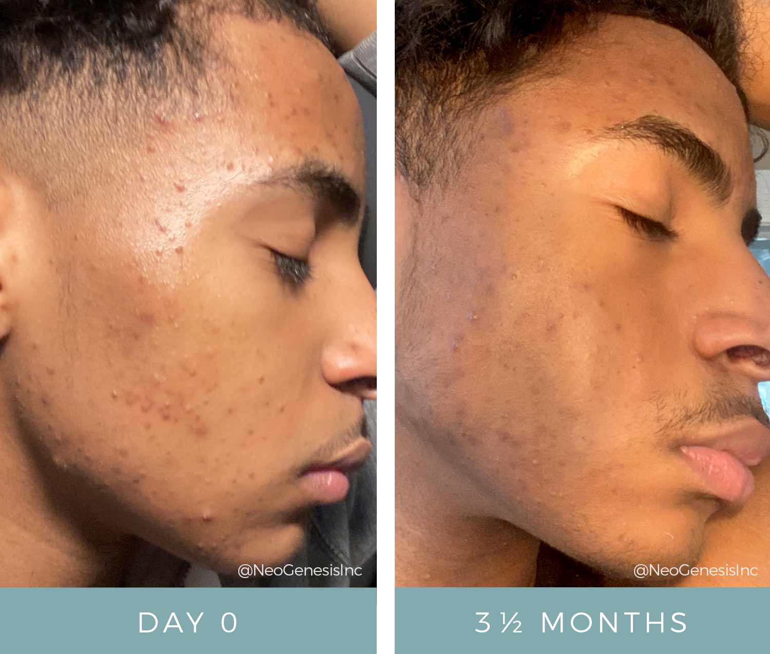Before & After - Acne Treatment