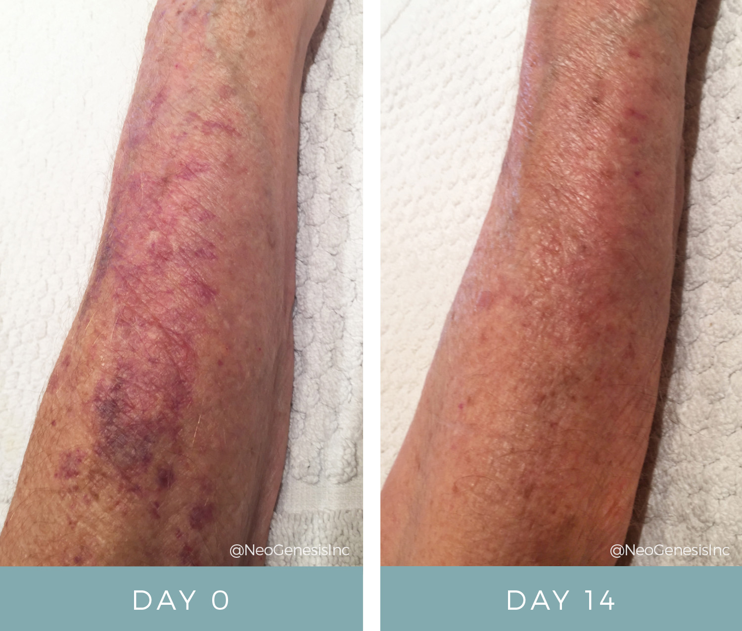 Before + Afters - Actinic Purpura