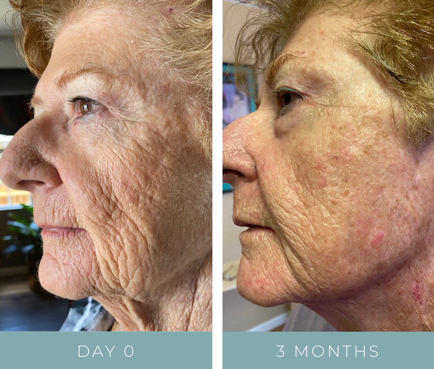 Before + After - Aging Skin - Face