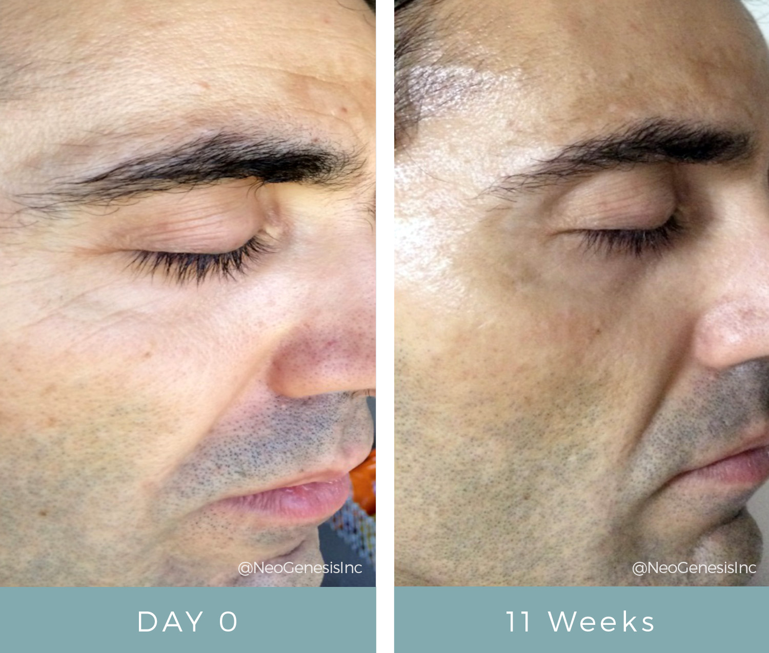 Before & After - Aging Skin - Male