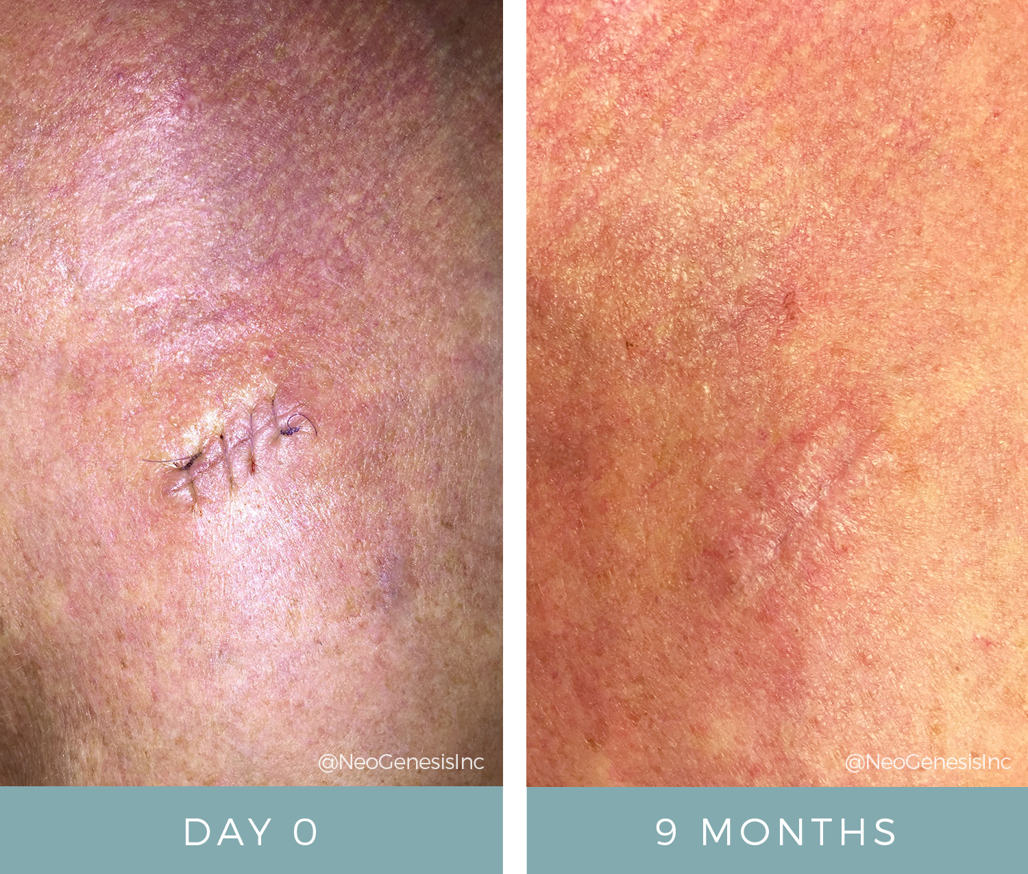 Before + After - Basal Cell Carcinoma