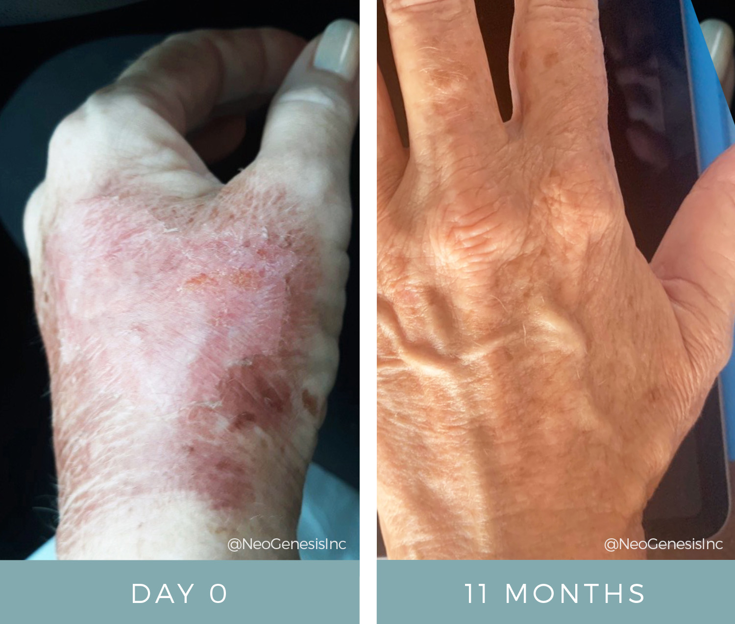 Before + After - Burns - Wound Care