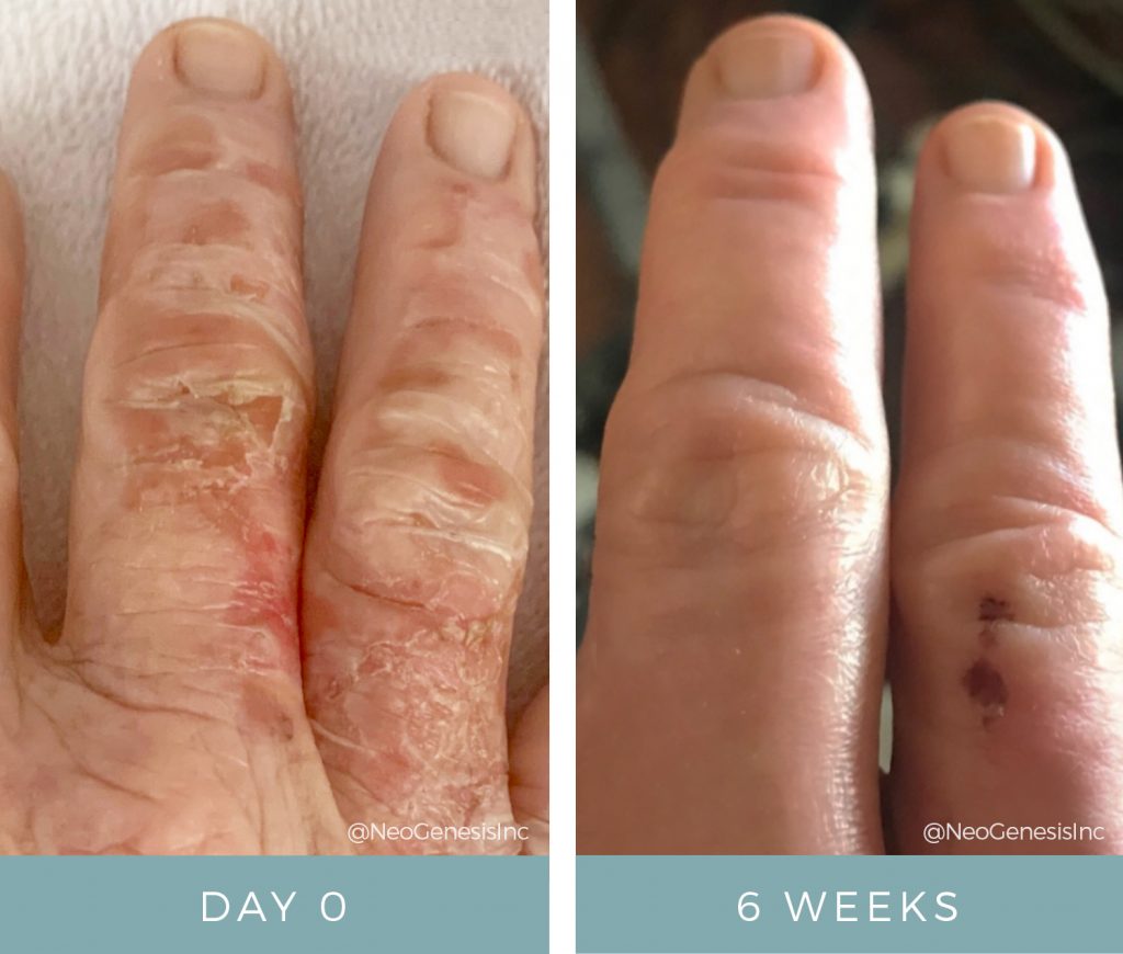 Before + After - Burns - Wound Care