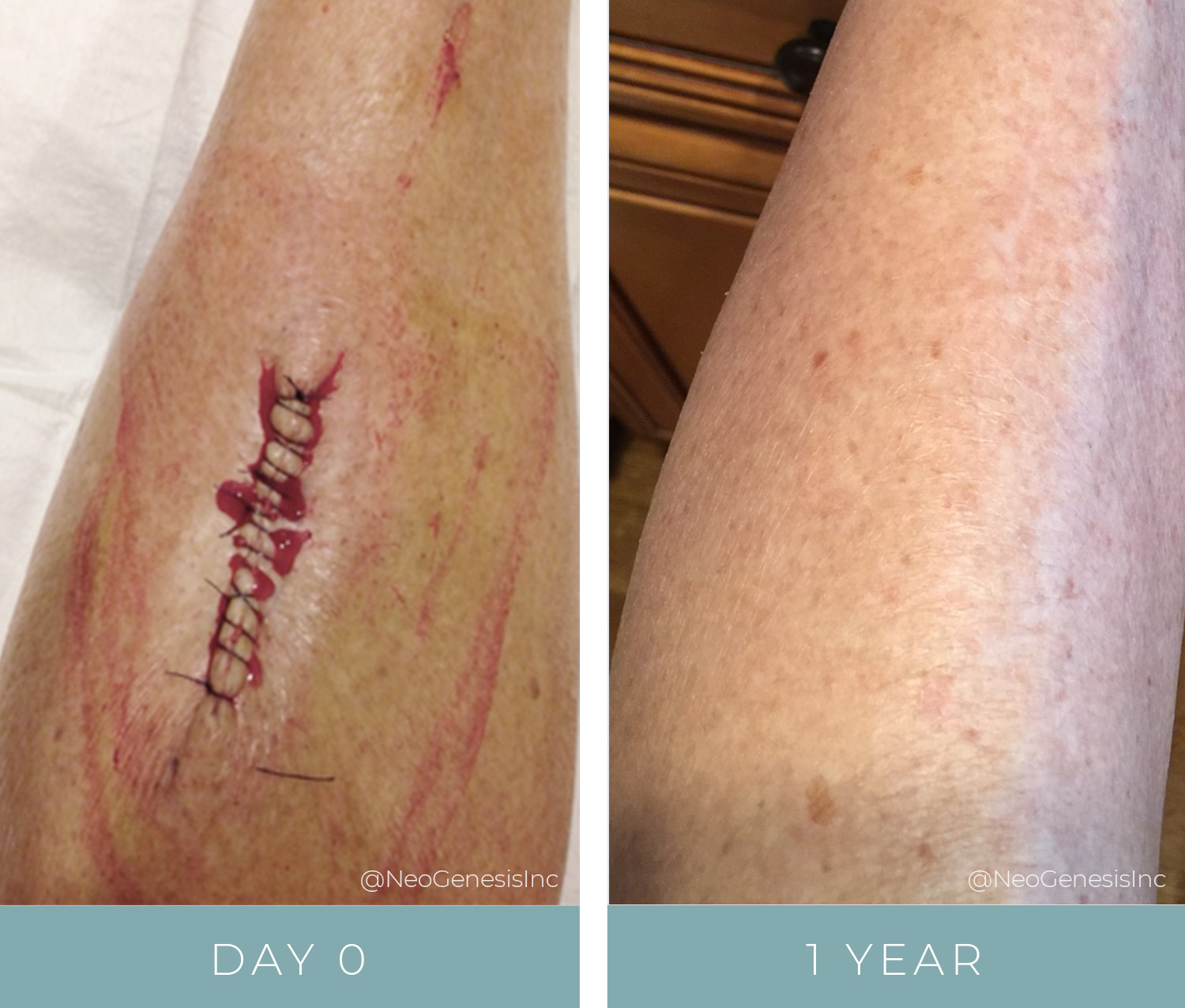 Before + After - Post Cancer Surgery Scar Reduction