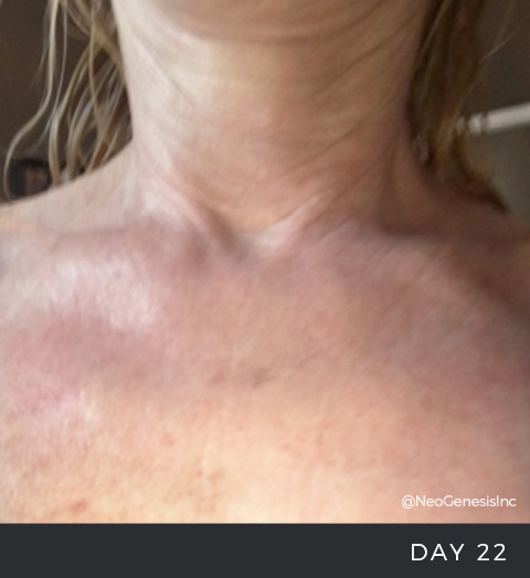 Chemical Peel - Before & After