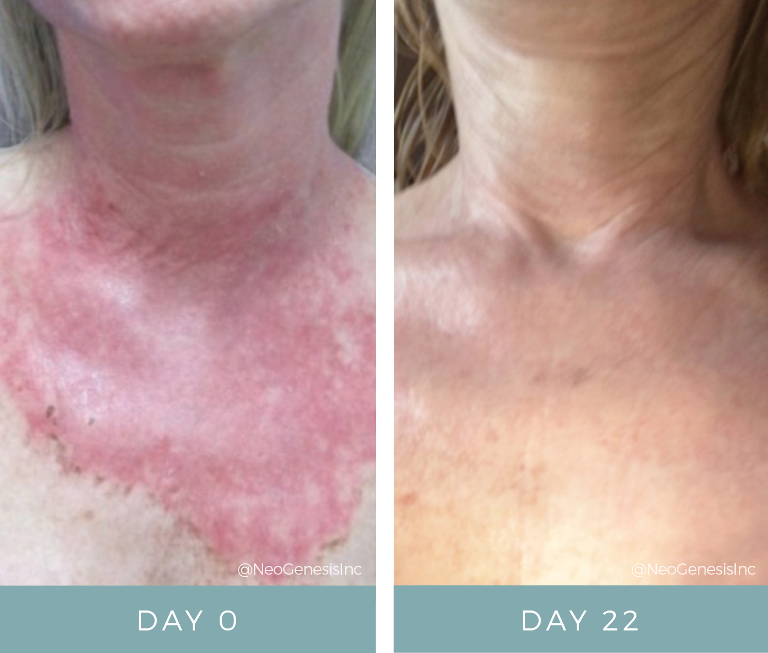 Before & After - Radiation + Chemical Peel