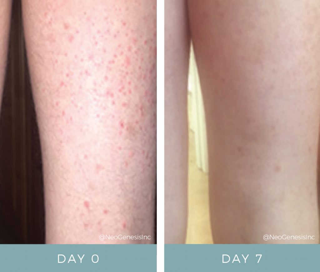 Before & After - Dermatitis