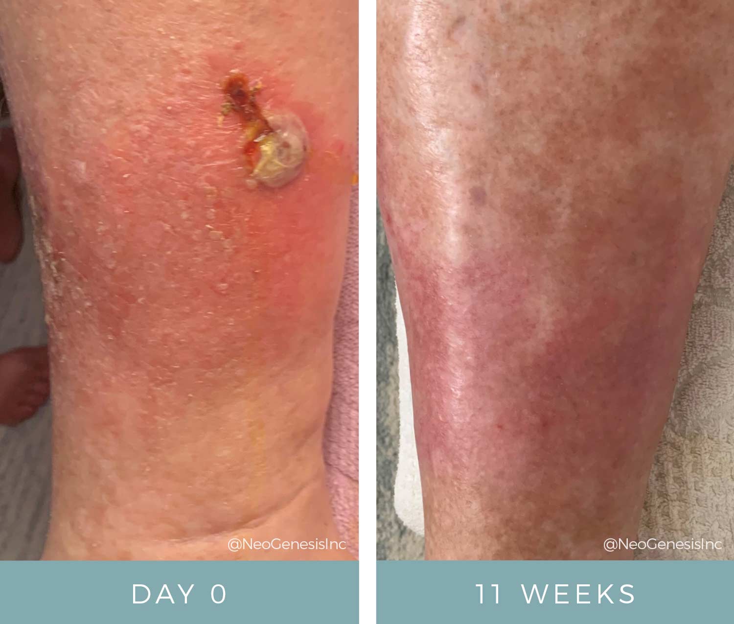 Skin + Hair Conditions - Before + Afters 2 - Diabetic Ulcers