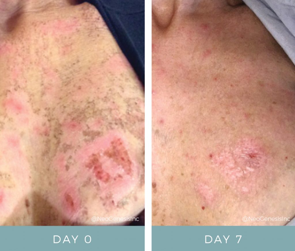 Before + After - Microneedling