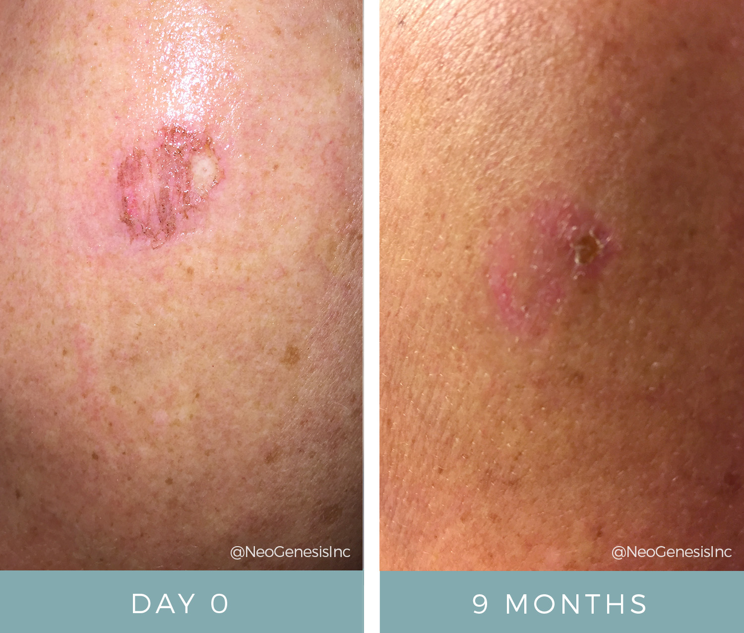Before & After - Melanoma Surgery