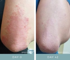 Before & After - Psoriasis