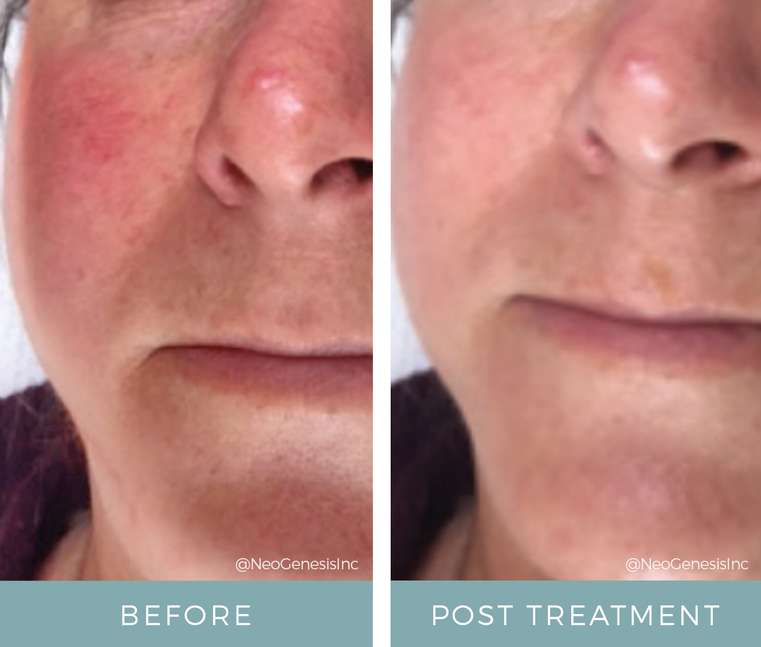 Before + After - Rosacea and Microcurrent