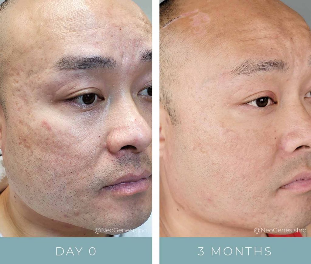 Before + After - Acne Scarring