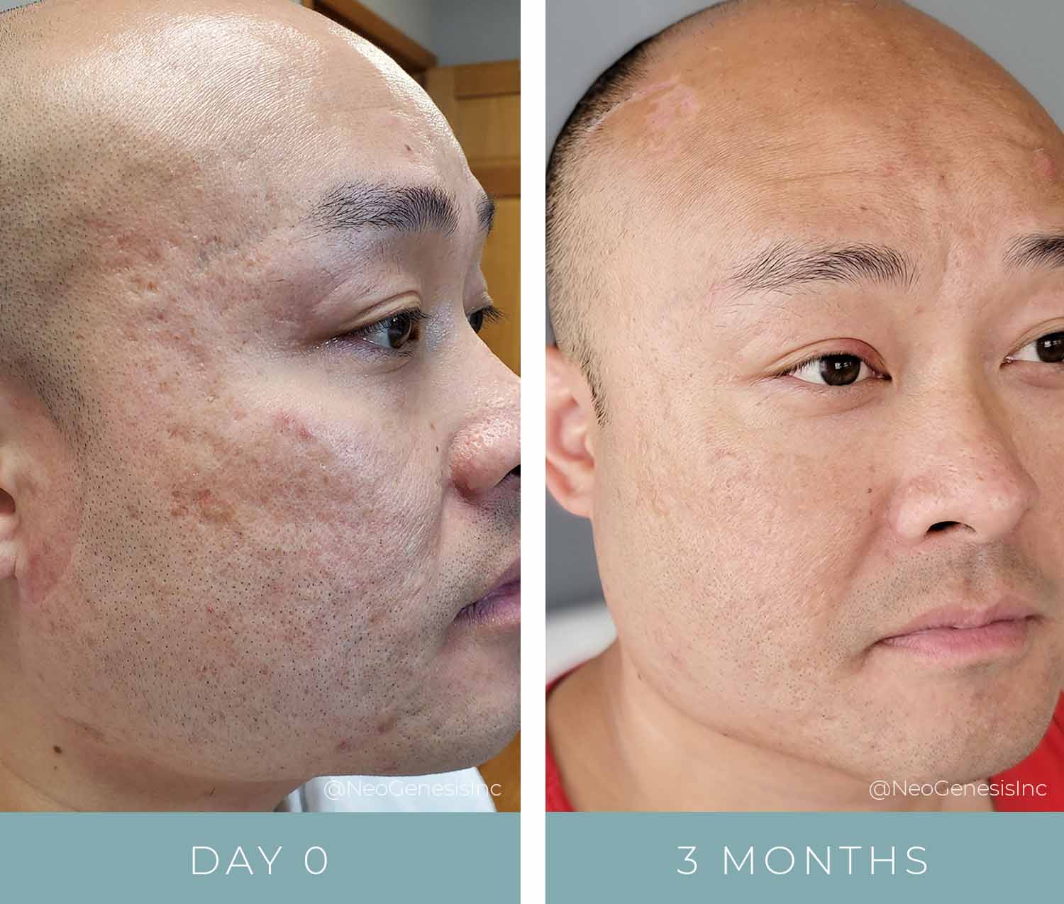 Before + After - Acne Scarring - Microneedling