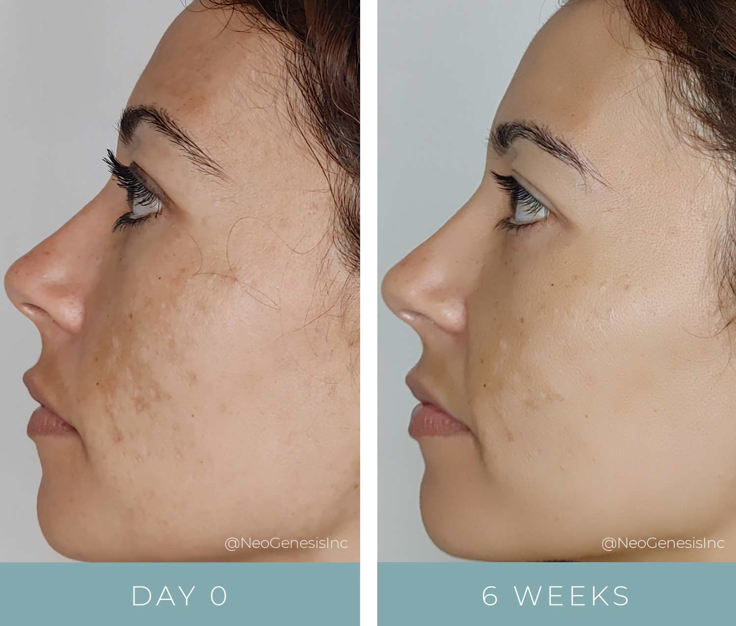Before + After - Hyperpigmentation - Microneedling