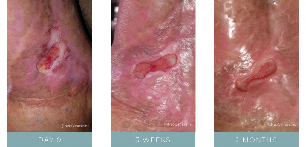 Before + After - Wound Care - Open Wound