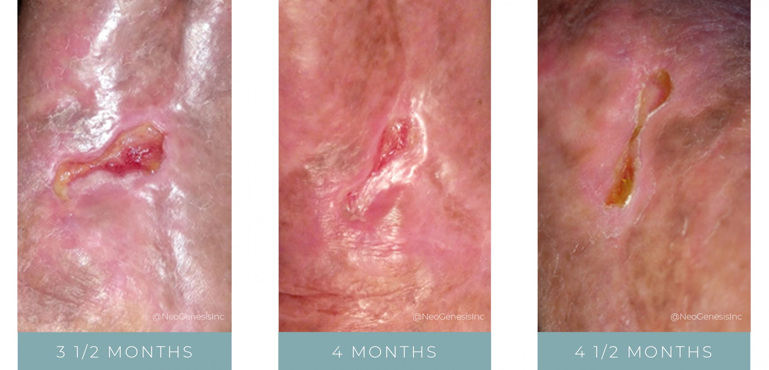 Before + After - Wound Care for Diabetic Ulcers