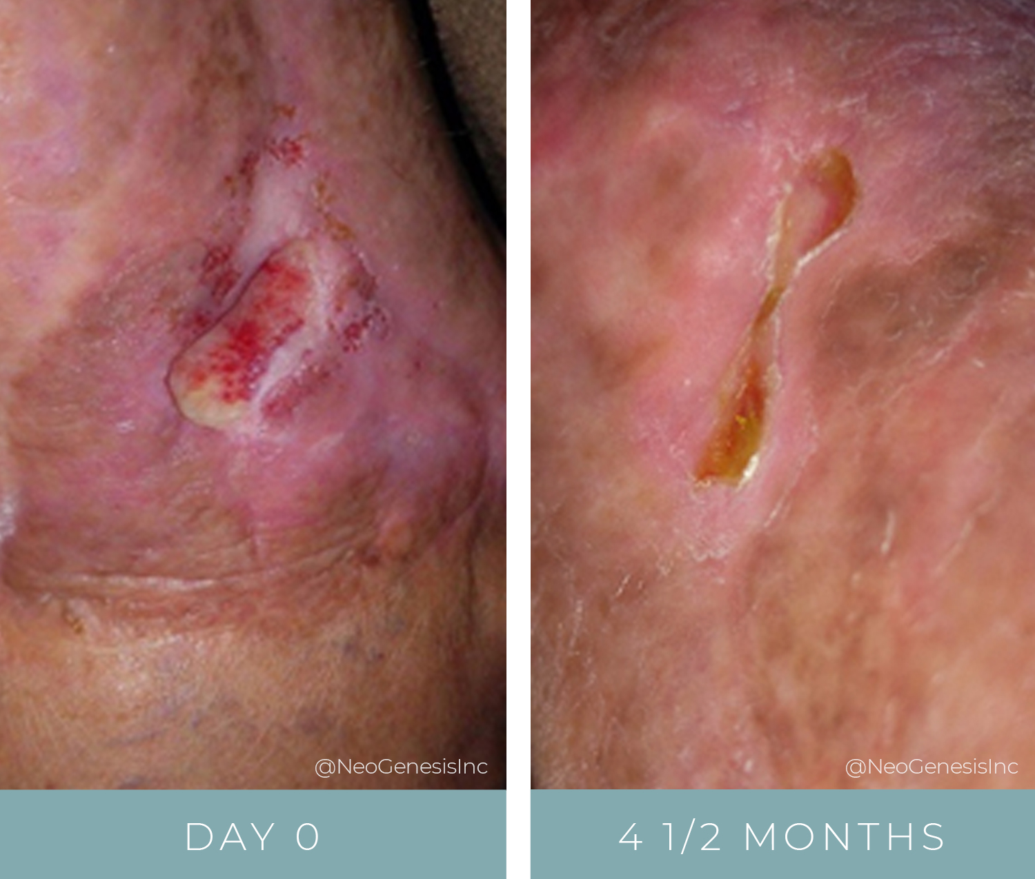 Before + After - Wound Care - Open Wound