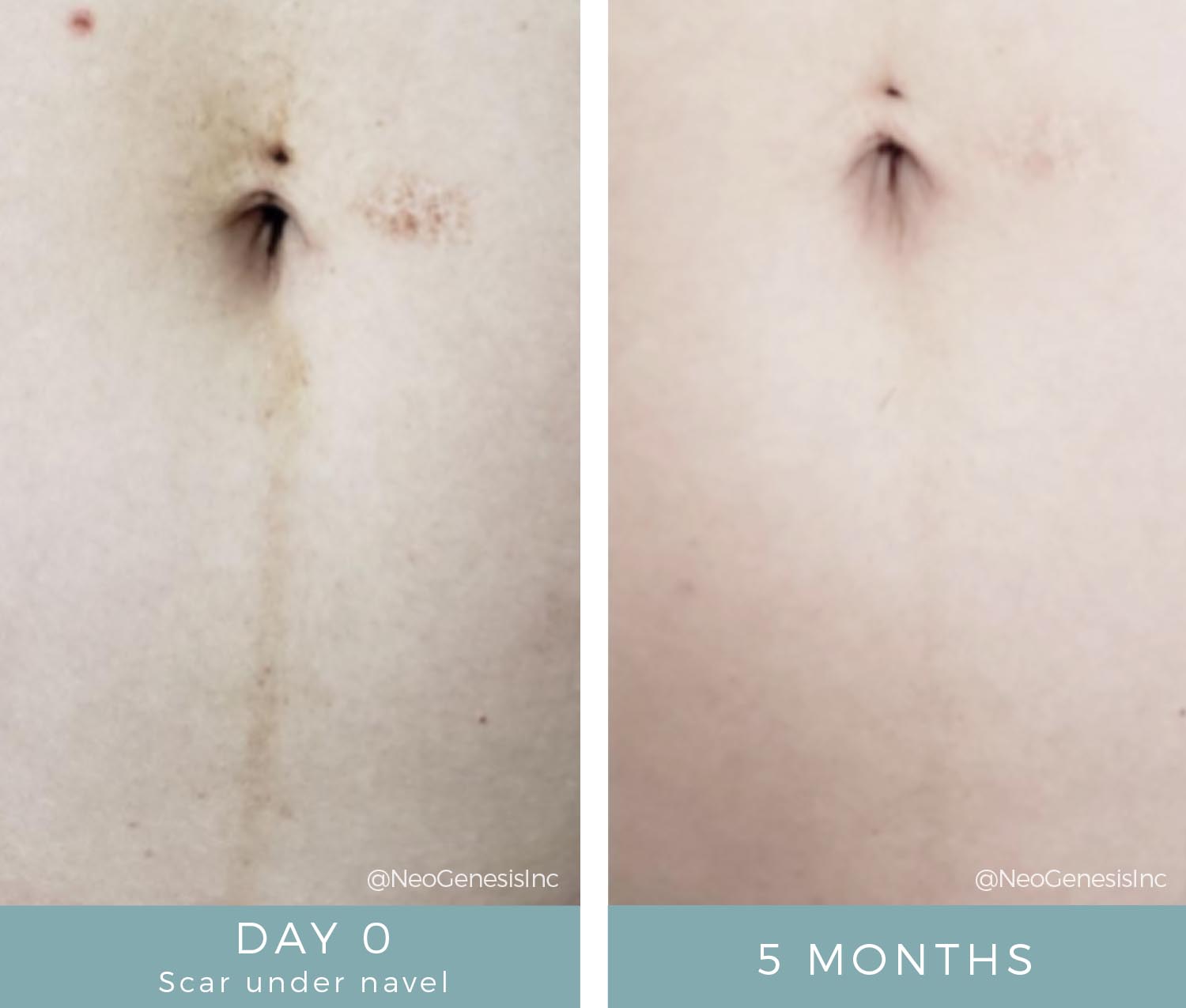 Before + Afters - Post Pregnancy Scar