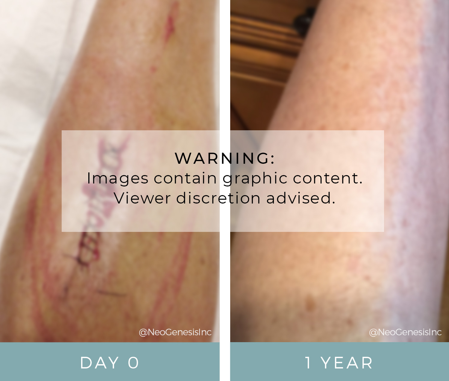 Oncology Before + Afters - Cancer Surgery Scarring