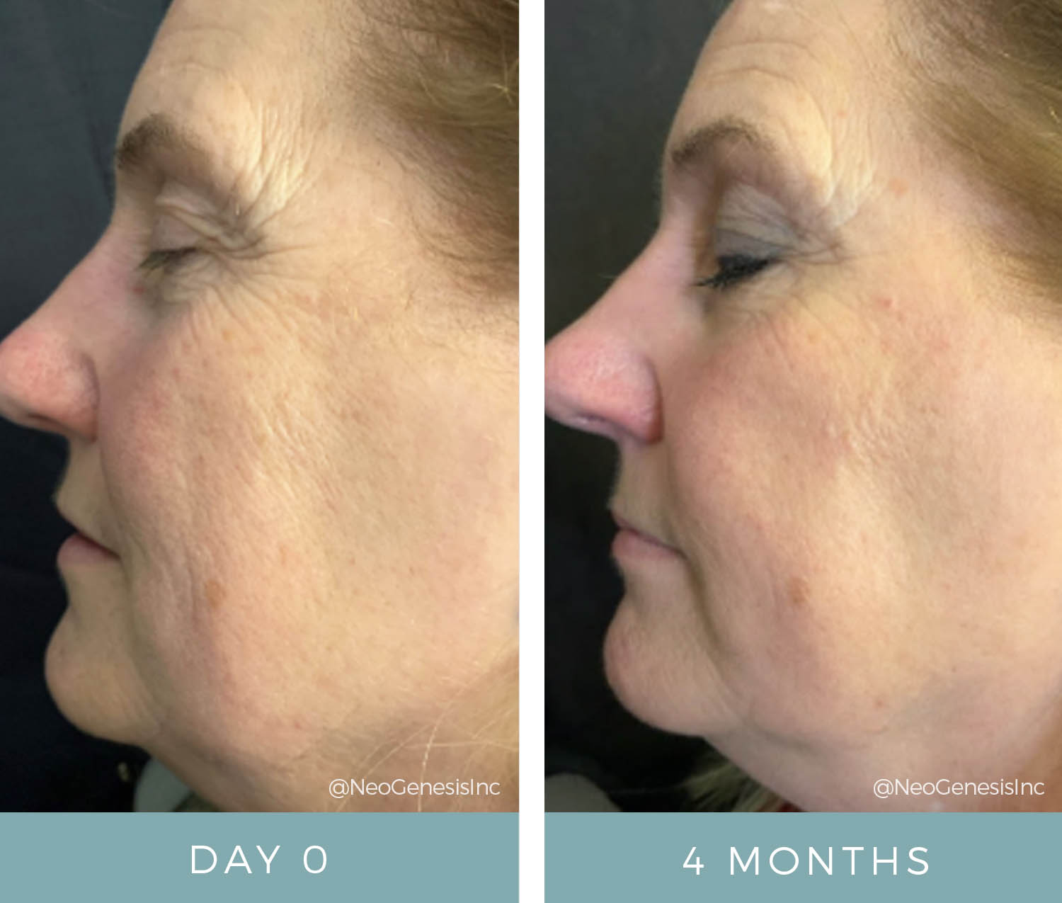 Before + After - Rosacea + Aging Skin