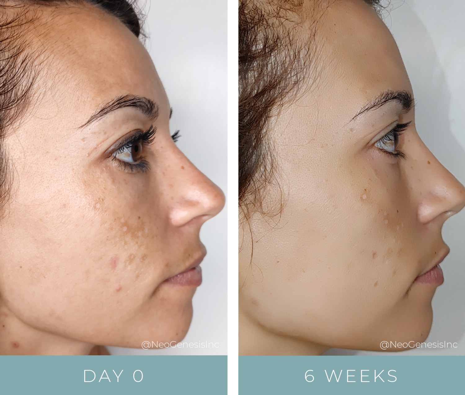 Before + After - Chemical Peel