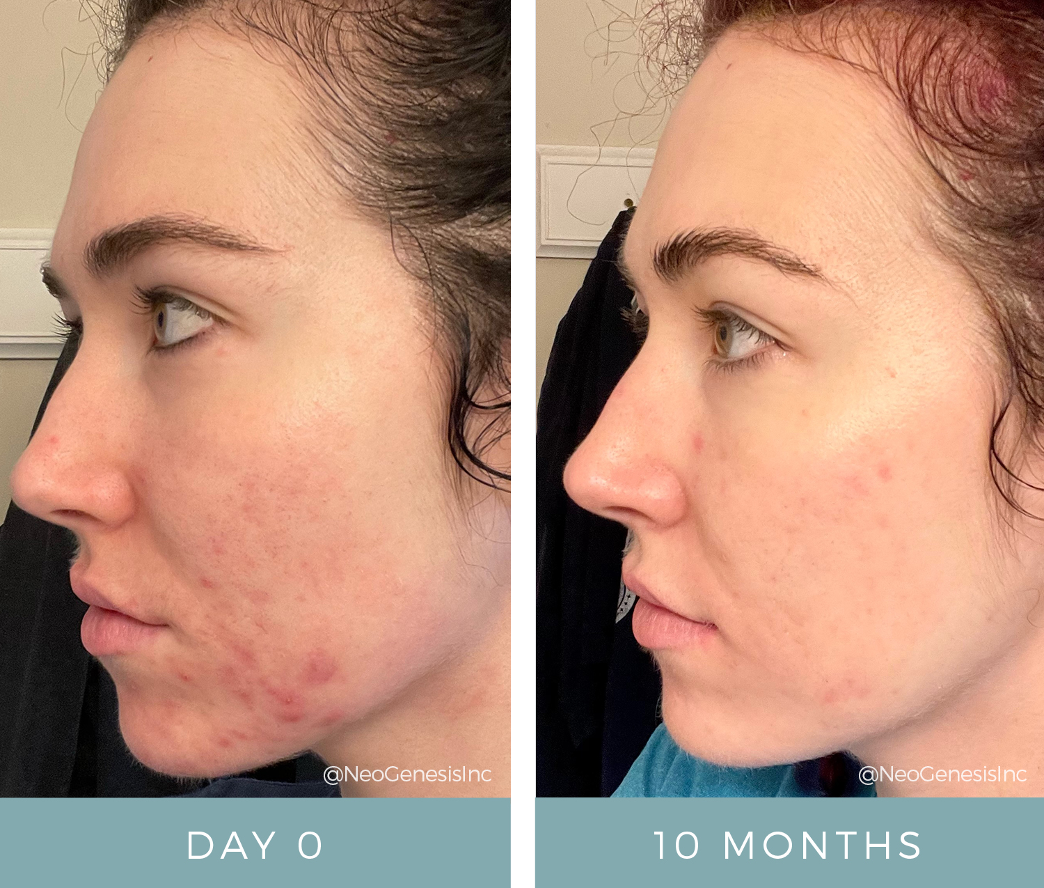 Hormonal Acne - Before + After