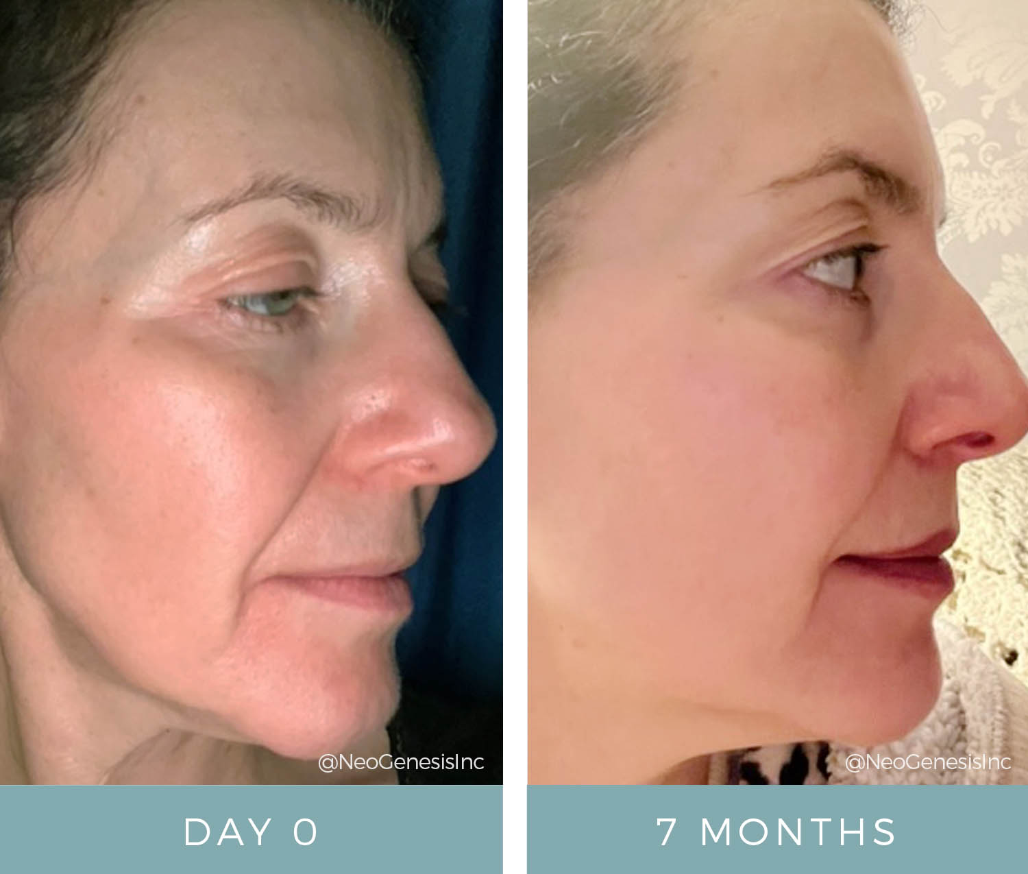 Before + After - Rosacea + Aging Skin + Eczema