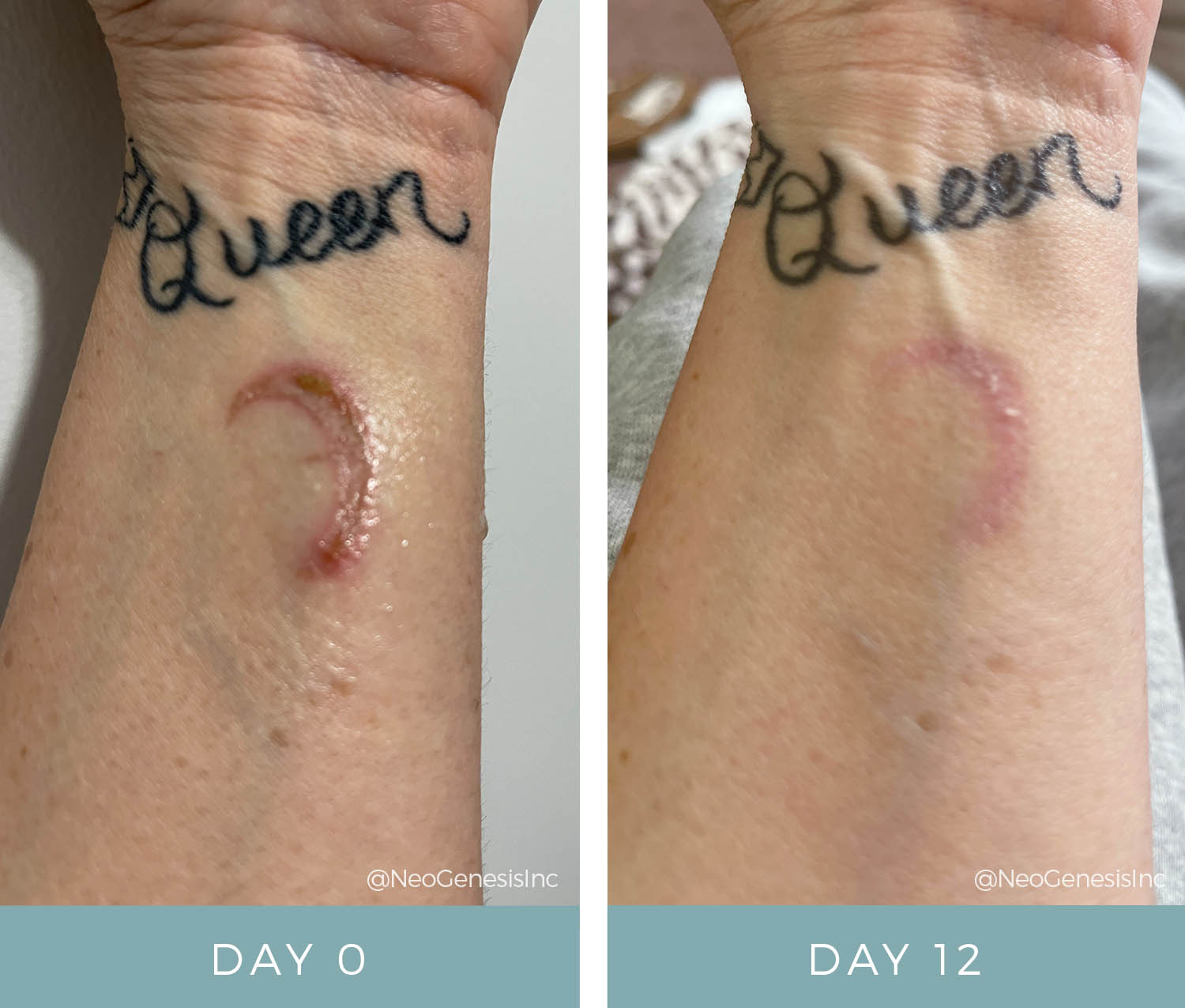 Before + After - Arm Burn