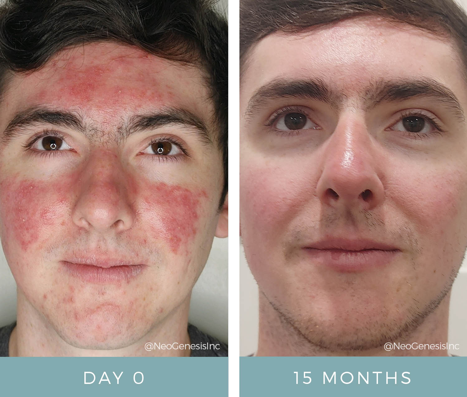 Before + After - Acne + Environmental Skin Issues