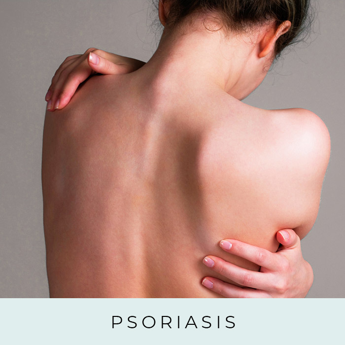 Products for Psoriasis