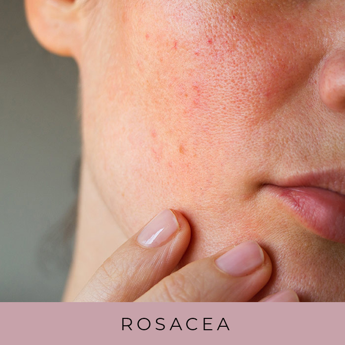 Products for Rosacea