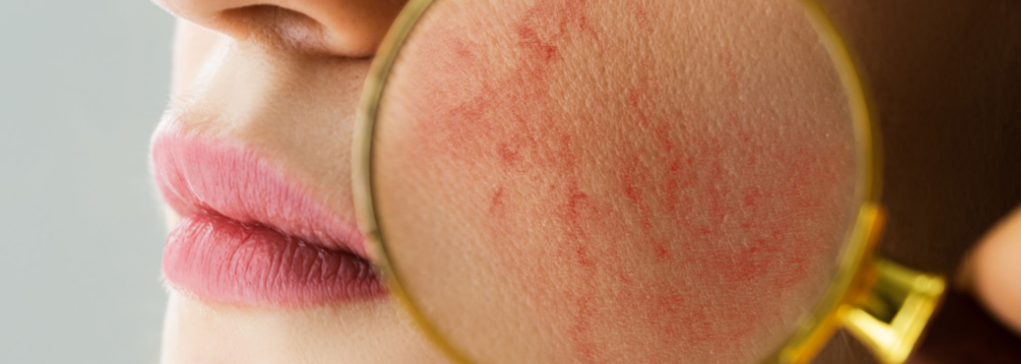 What is Rosacea? Caring for Rosacea-Prone Skin
