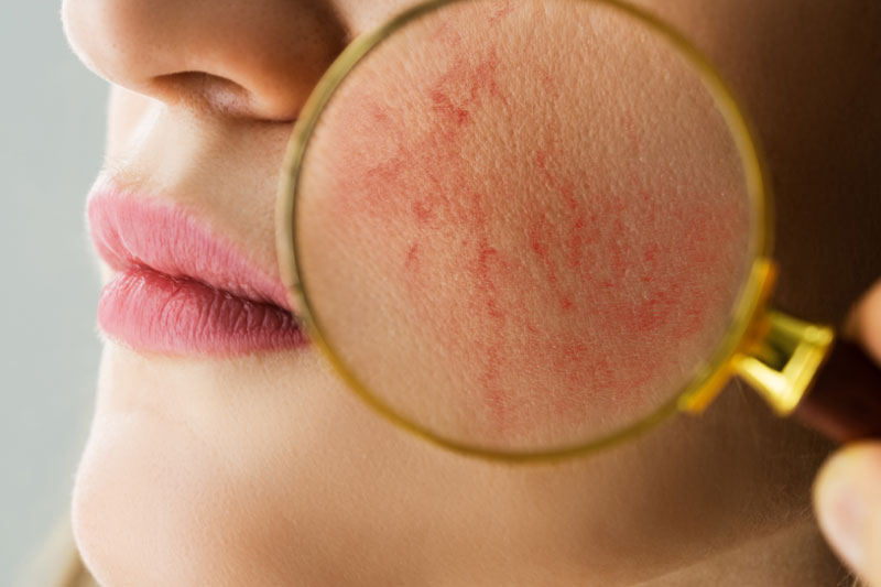What is Rosacea? Caring for Rosacea-Prone Skin