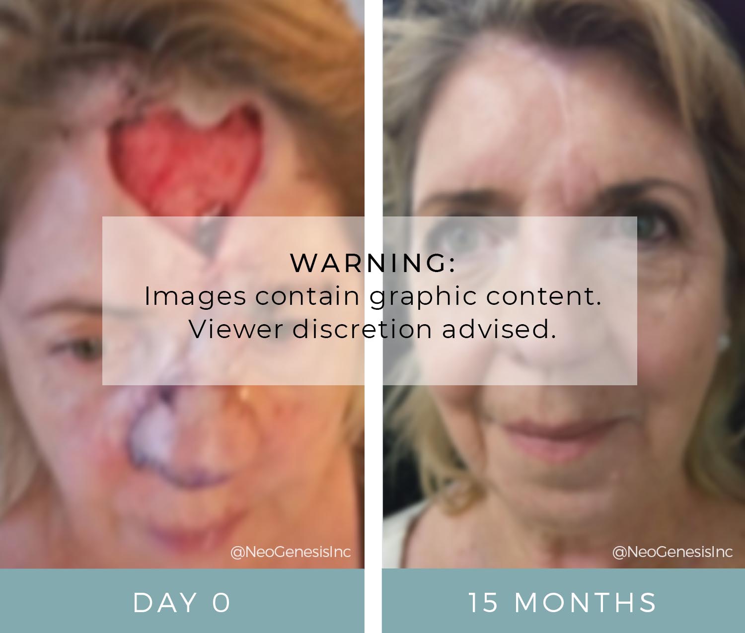Before + After - Basal Cell Carcinoma - Cancer Surgery