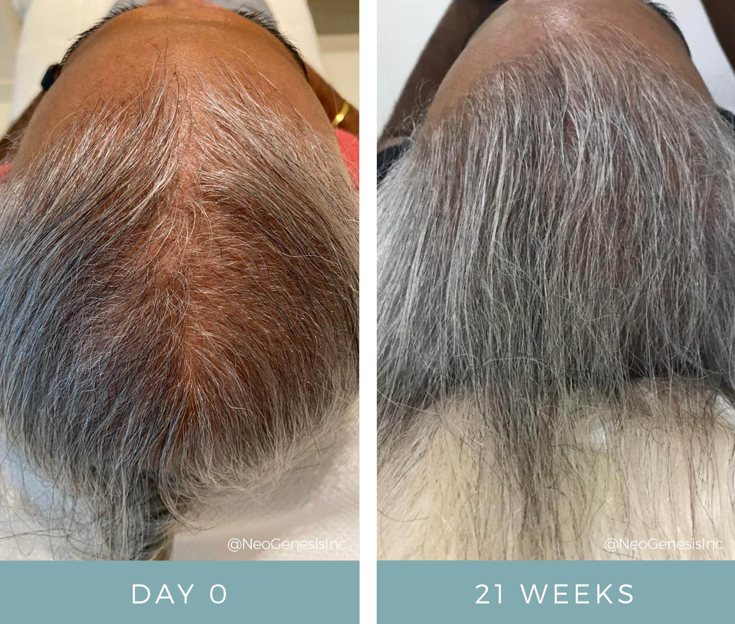 Before + After - Hair Loss + Microneedling