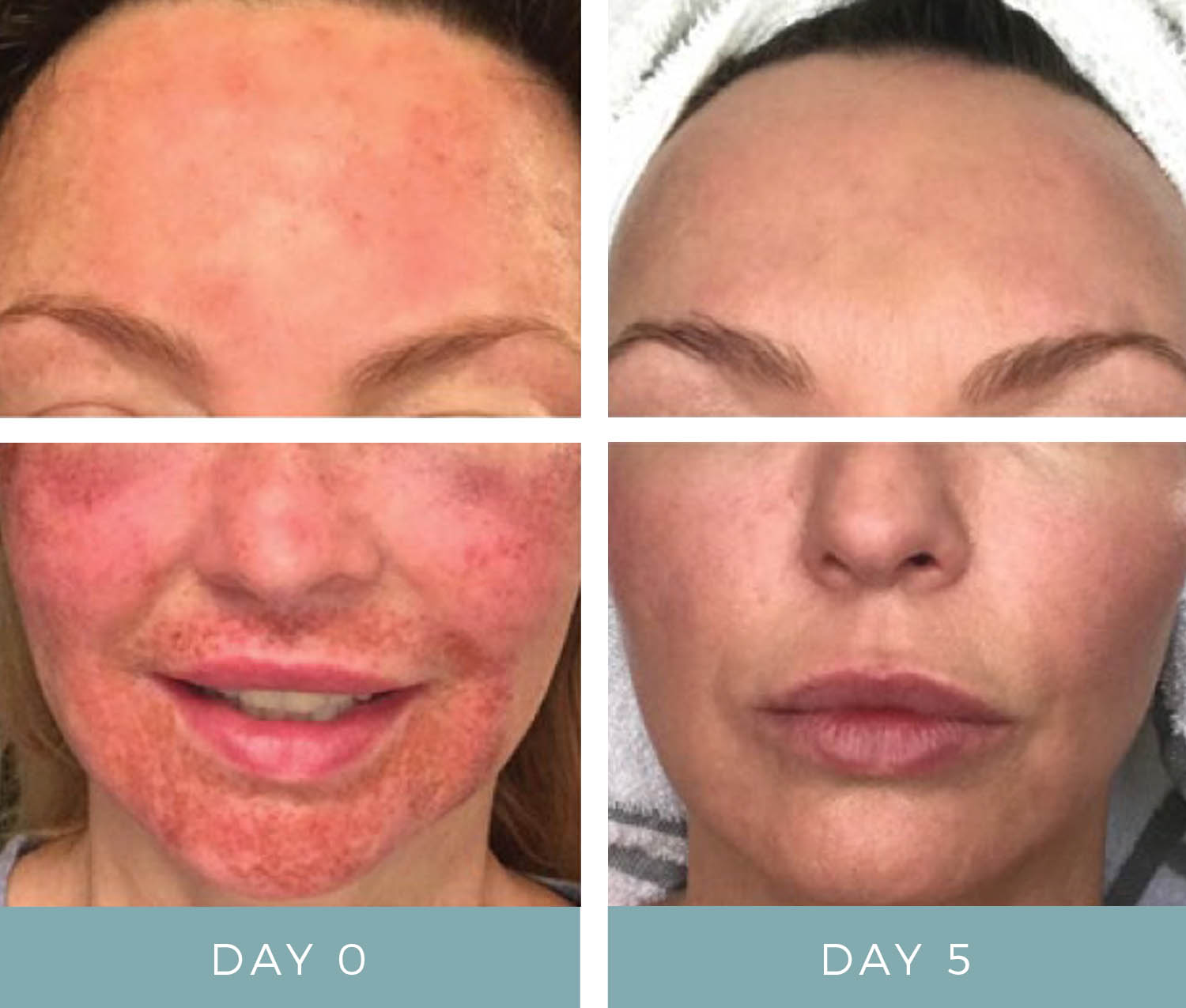 Before + After - C02 Laser Treatment