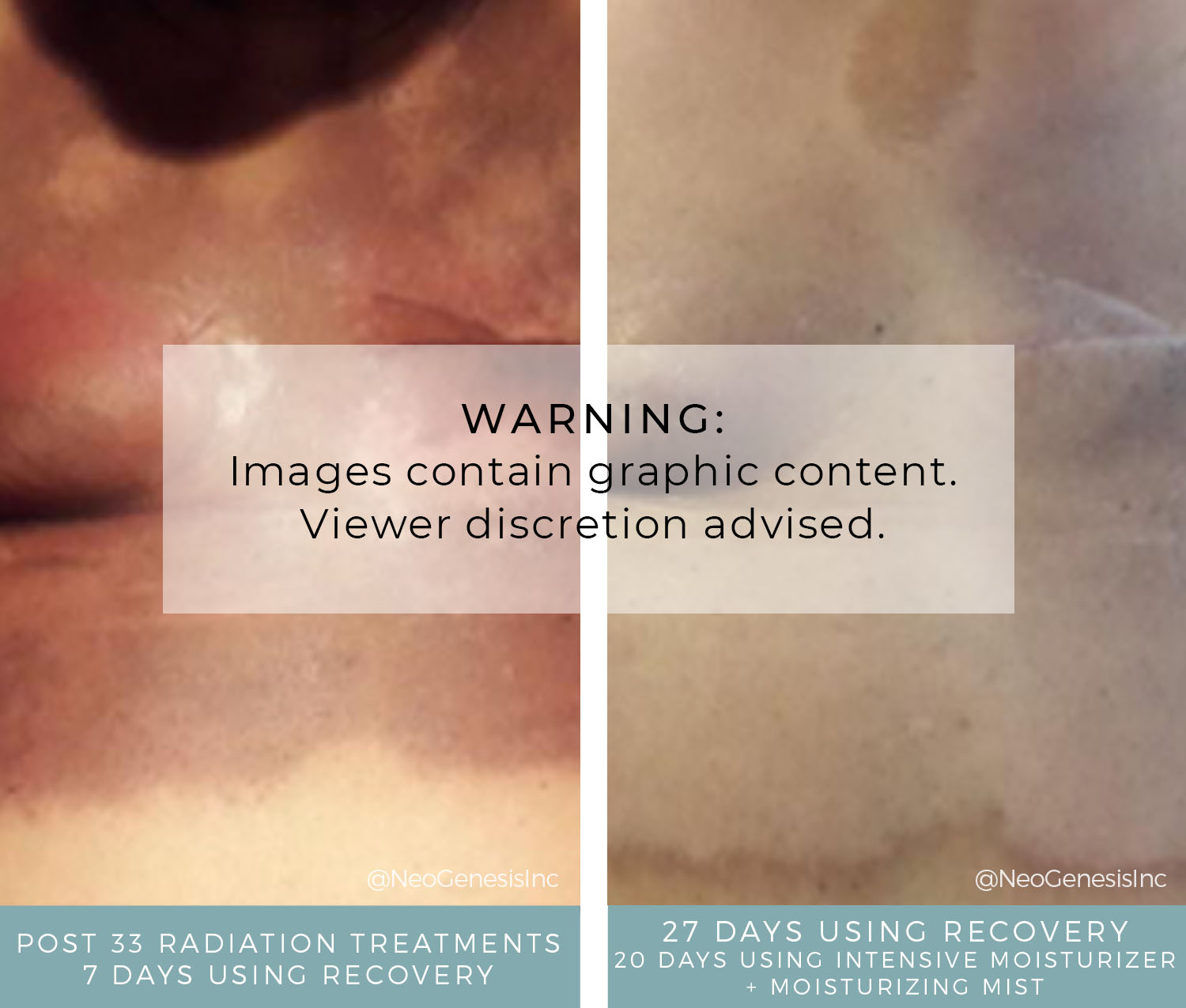 Before + After - Skincare for Radiation Burns