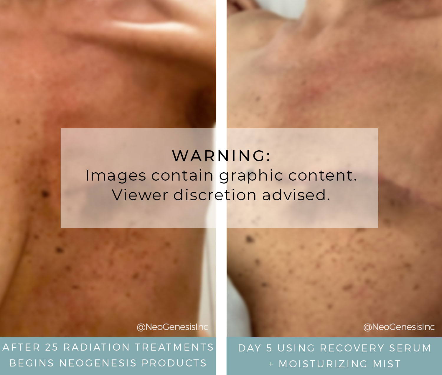 Before + After - Radiation Burns