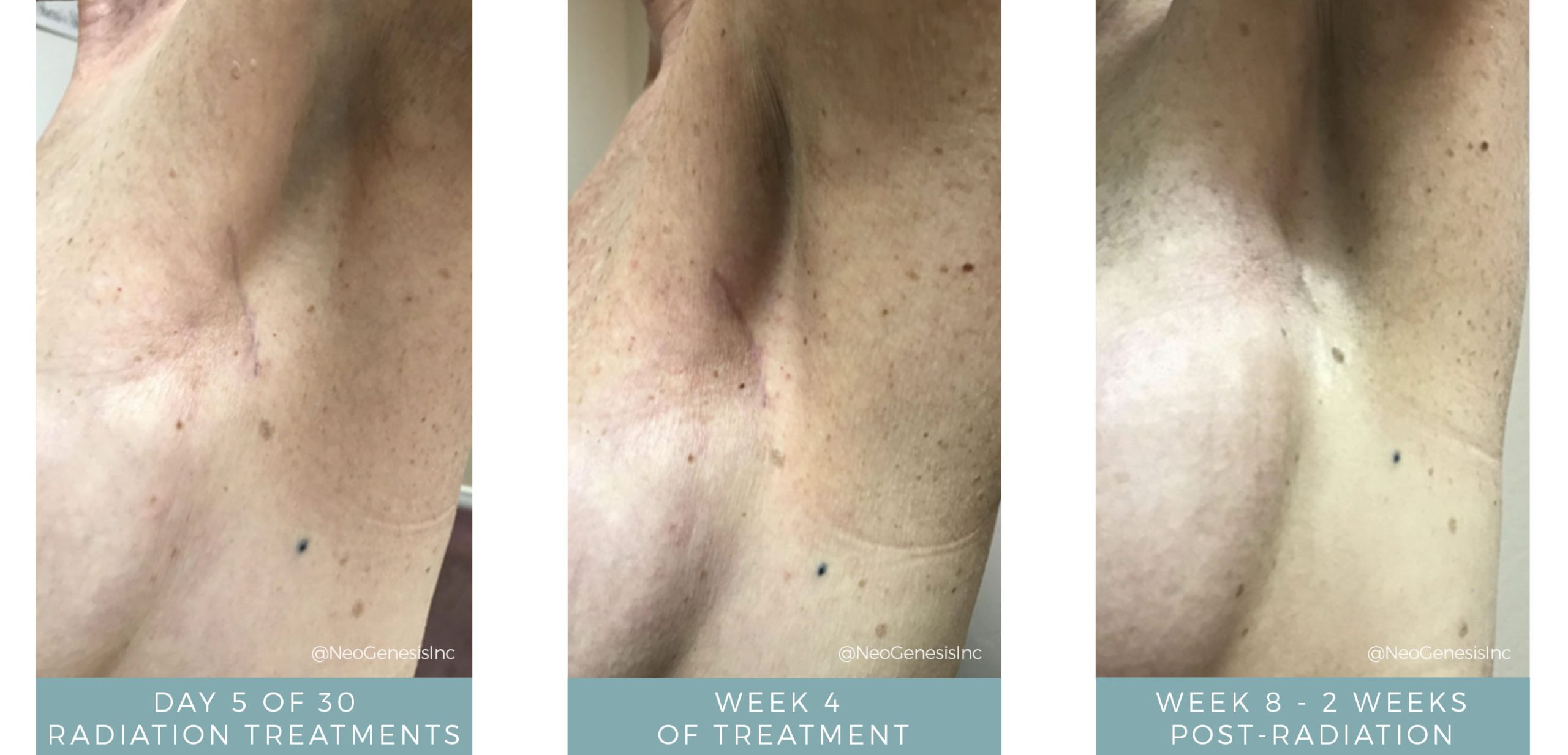Radiation Skin Care: Before + After - Radiation Treatments using NeoGenesis products