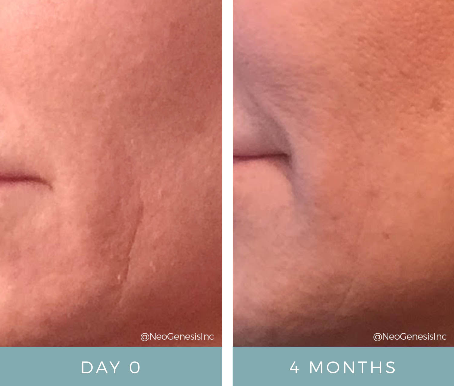Before + After - Radio Frequency Skin Tightening Scar