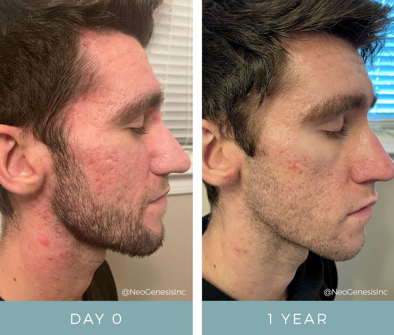 Before + After- Acne + Acne Scarring - Right Side