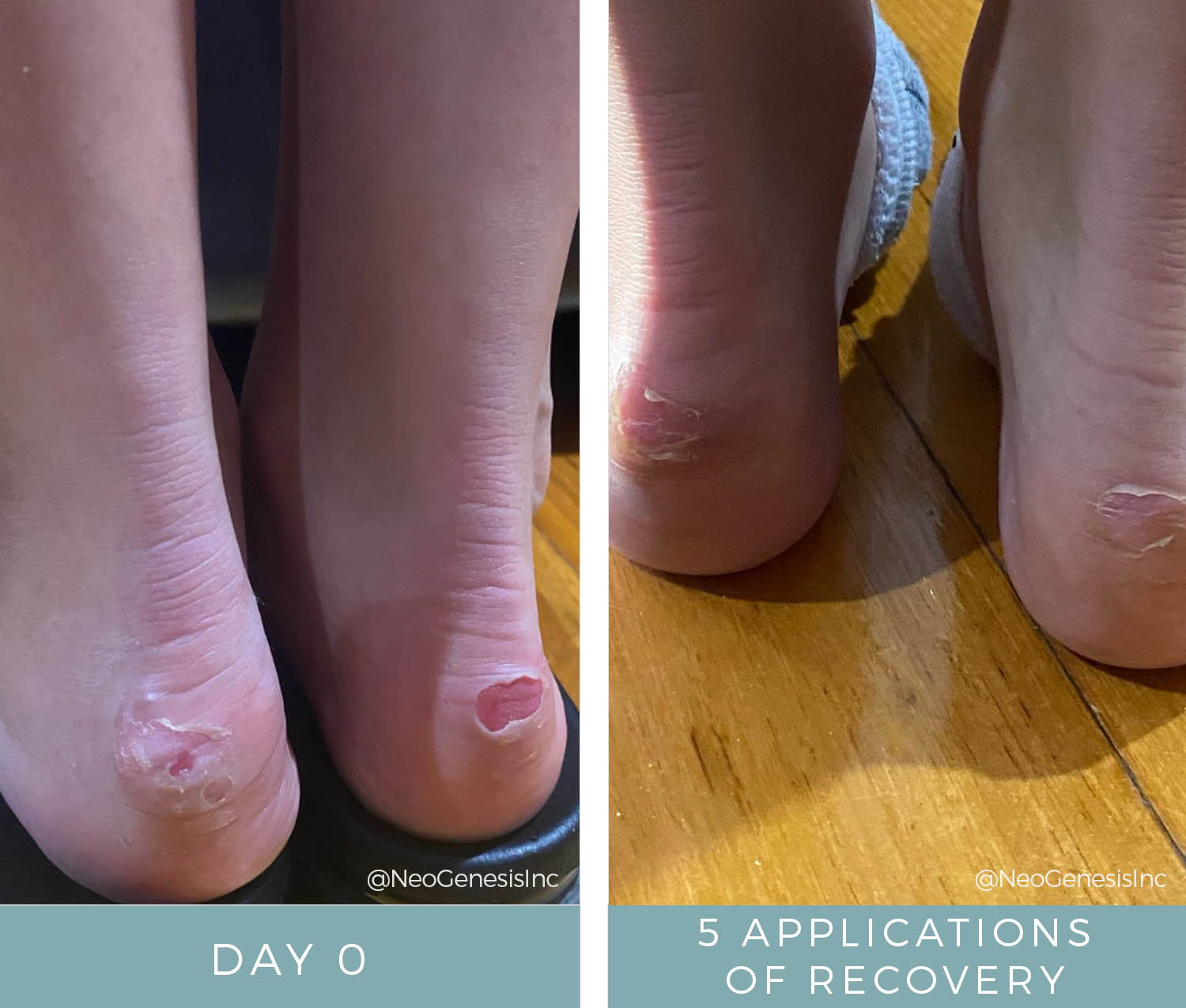 Before + After - Ballerina Blisters