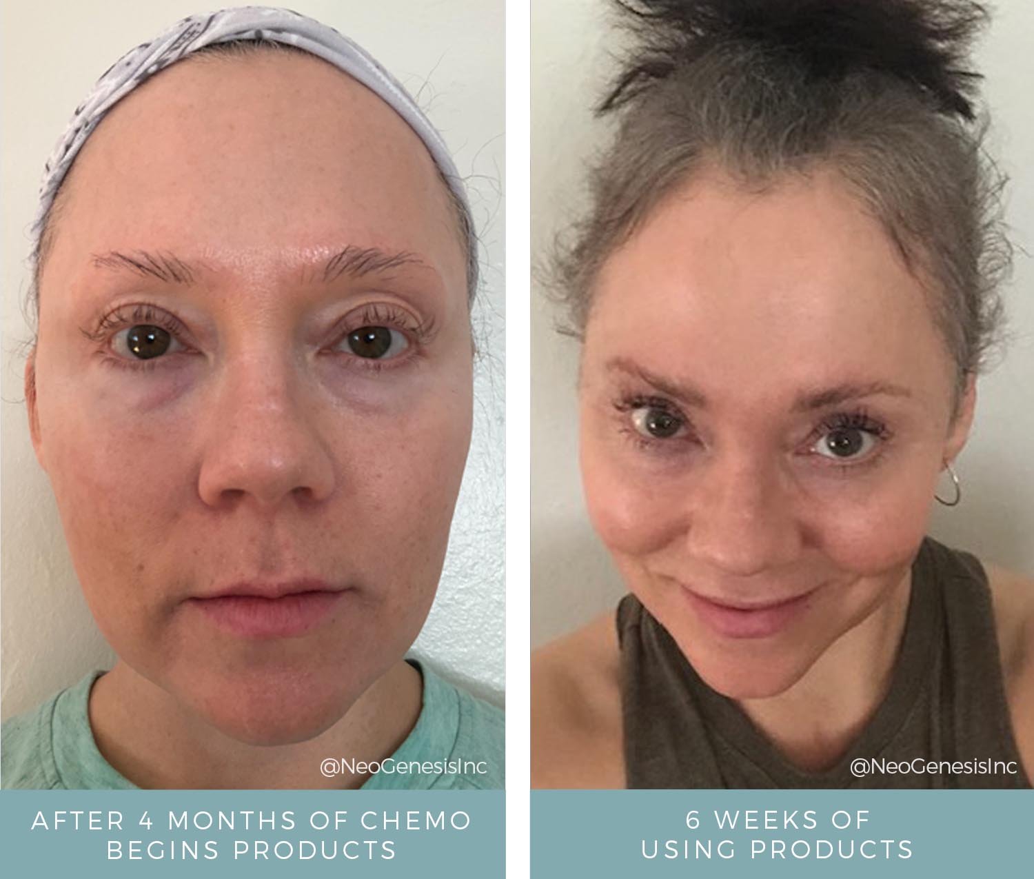 Oncology Before + After - Chemo Side Effects - Hair Lash and Brow Loss