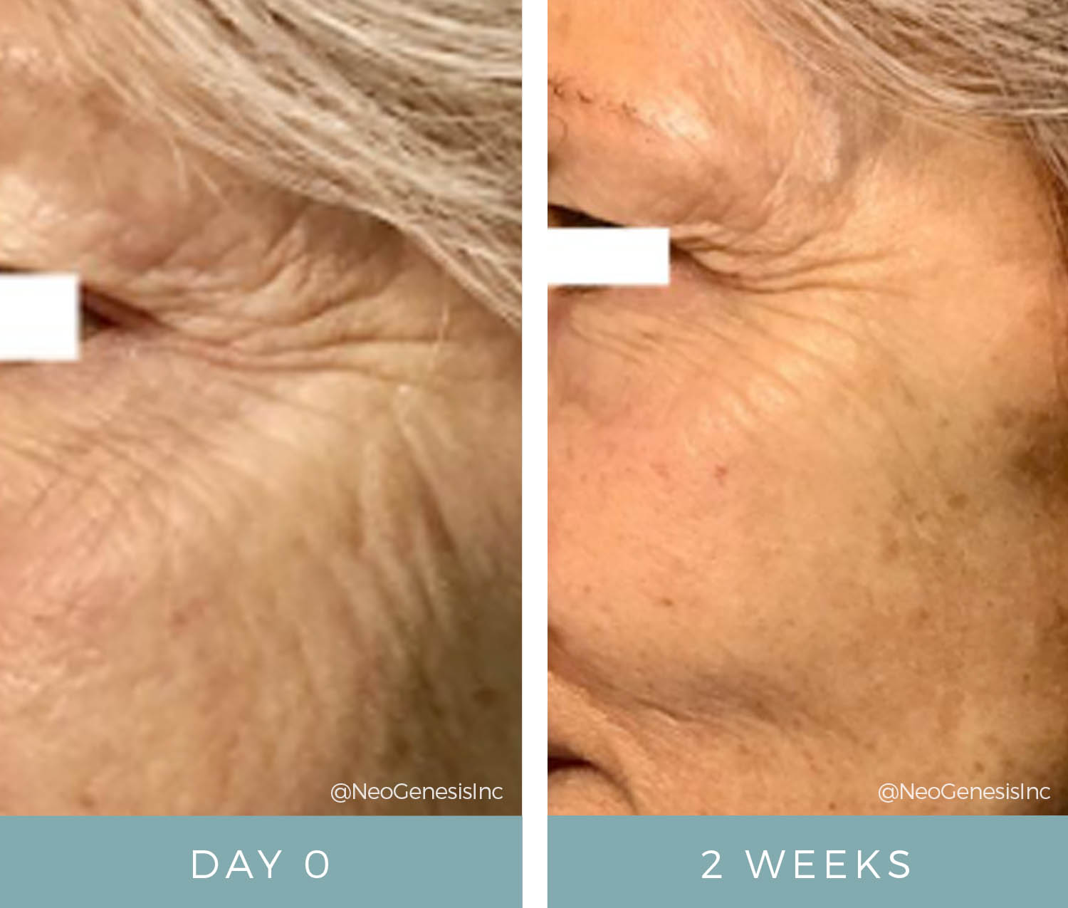 Before + After - Fibroblast - NeoGenesis Recovery serum