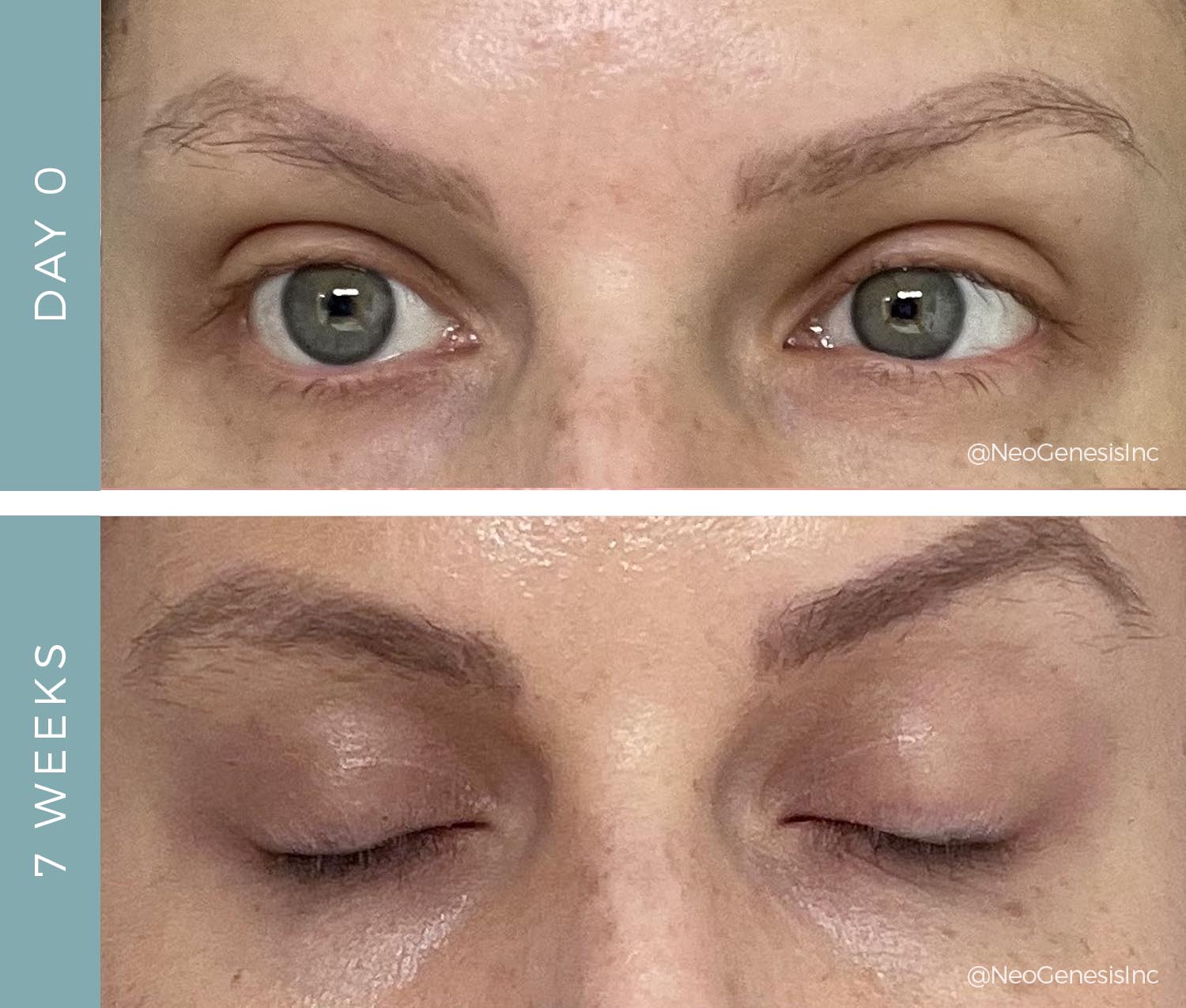 Chemo side effects - Lash + Brow loss - Before + After