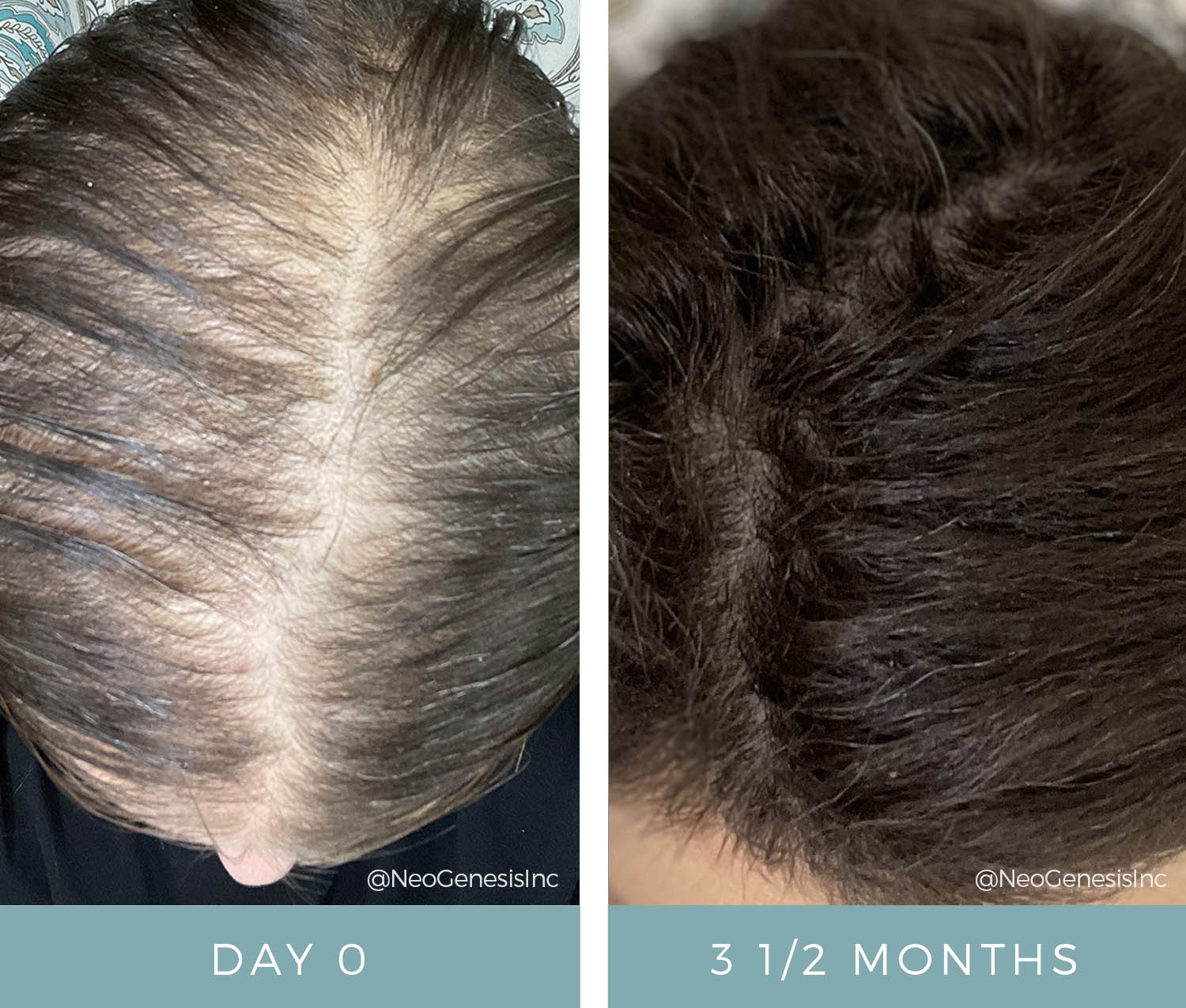 Chemo side effects - Hair Loss