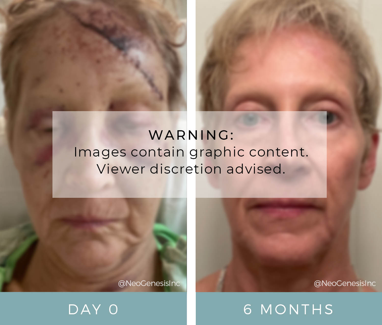 Before + After - Car Accident Wound Care + Scarring